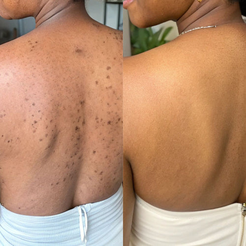 Savon Anti-taches au Curcuma et à l'Acide Kojique